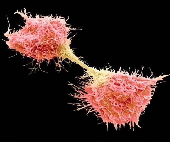 Медики перечислили неочевидные симптомы раковой опухоли