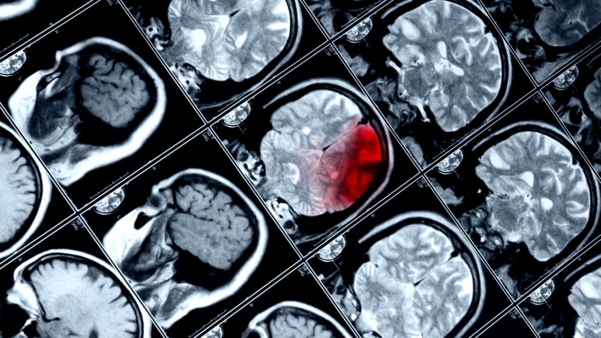 Длительность лечения черепно-мозговой травмы стало возможно предсказать по анализу крови