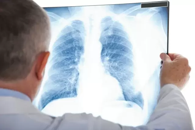 Четыре признака, что у вас рак лёгких