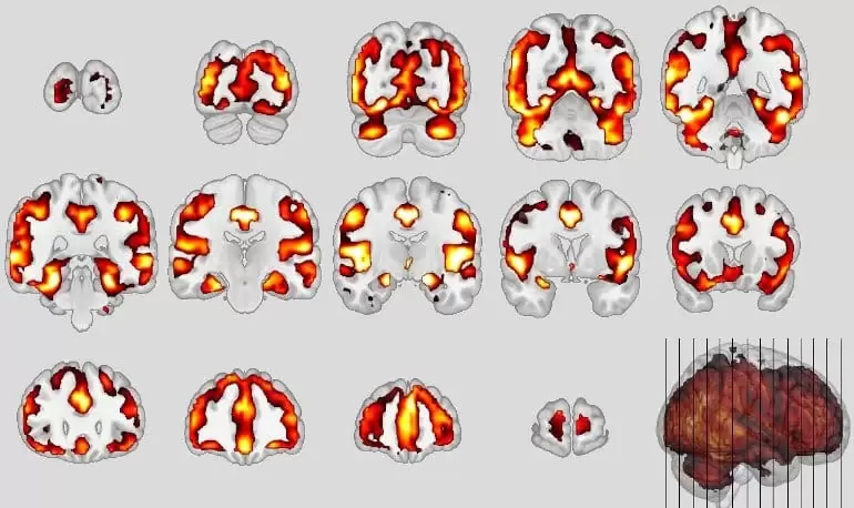 Учёные нашли сходство между шизофренией и старческим слабоумием