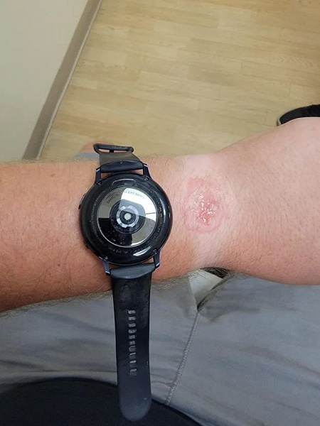Опасно для здоровья: «умные» часы Samsung Galaxy Watch обожгли владельца во сне